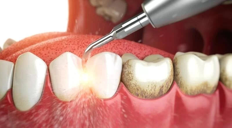 Профессиональная чистка зубов ультразвуком и ее преимущества