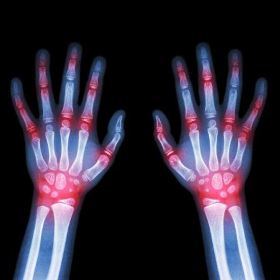 Ревматоїдний артрит: симптоми, причини і лікування