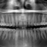 Панорамный снимок зубов как отличный диагностический метод